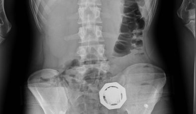 Eroin dolu mideyle 500 kilometre yol yaptılar